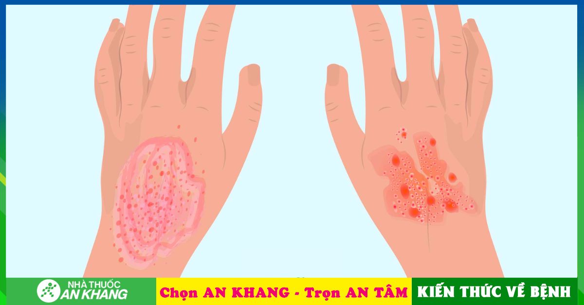 Chữa trị trị bệnh chàm tại nhà hiệu quả với phương pháp tự nhiên