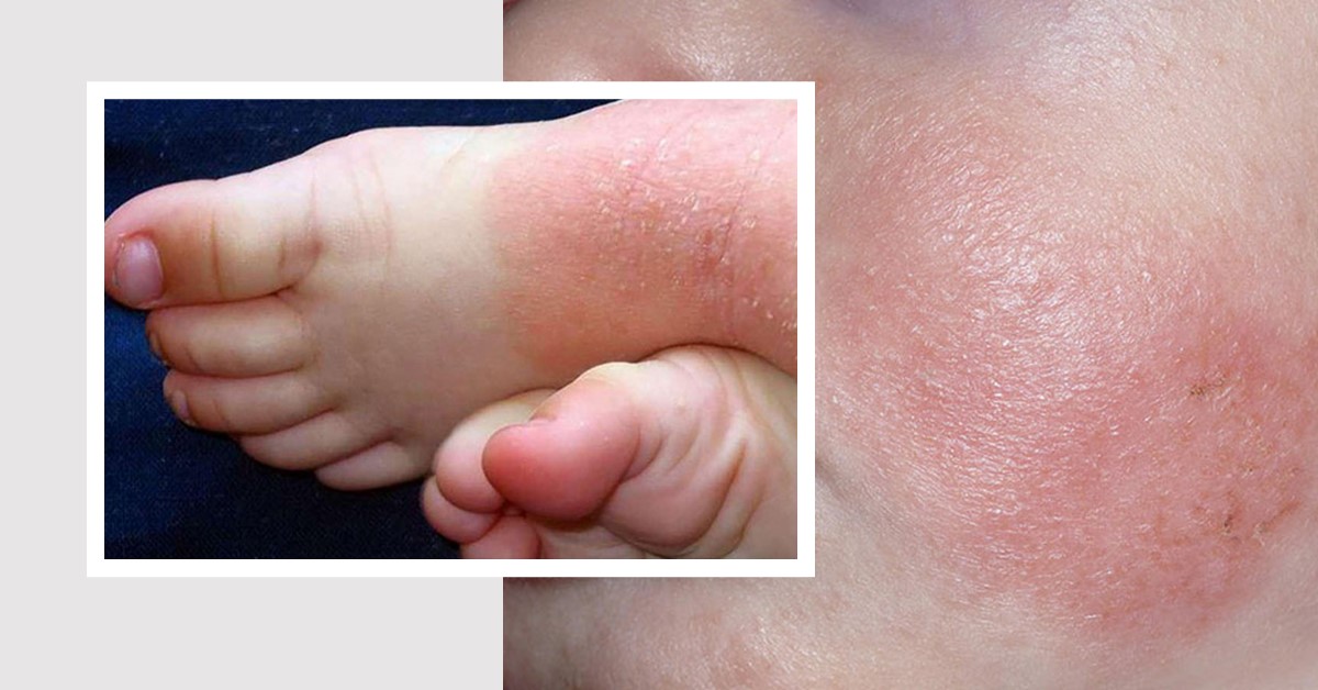 Dấu hiệu trẻ bị vẩy nến mà ba mẹ cần chú ý