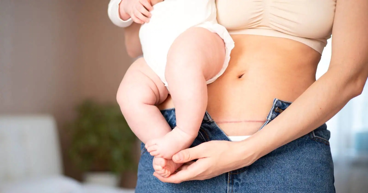 Sinh mổ được mấy lần? Bà bầu có thể sinh mổ lần 3 trở lên không?