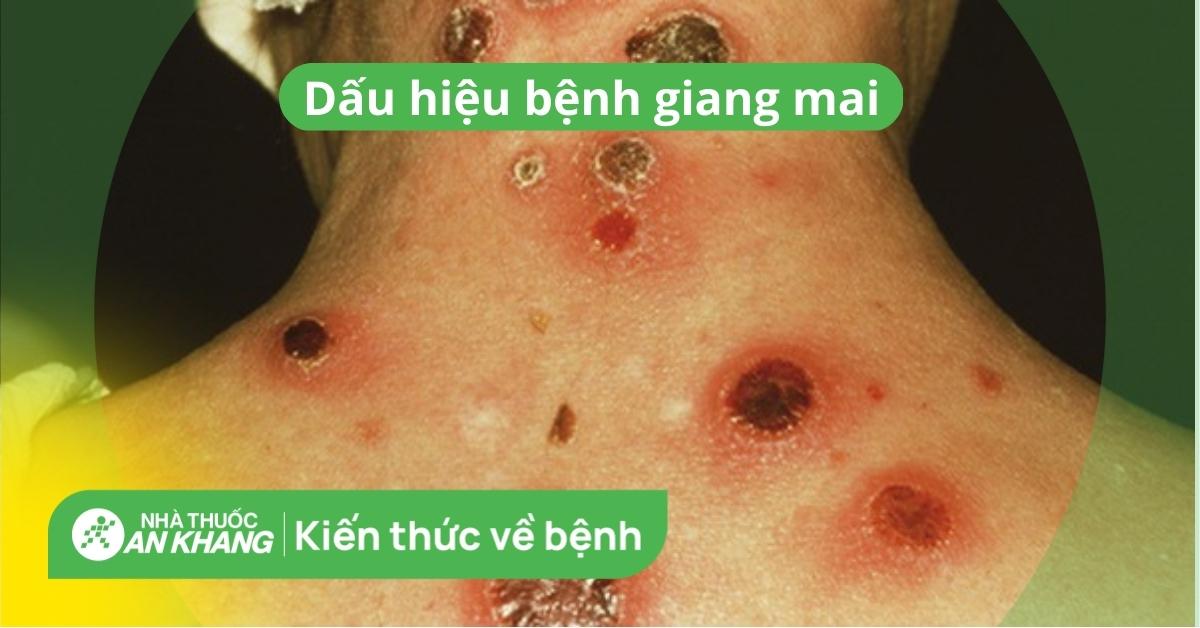 Các triệu chứng khác của giang mai ngoài thương tổn sẩn ướt là gì?
