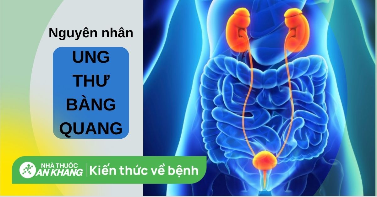 8 nguyên nhân ung thư bàng quang bạn không nên bỏ qua