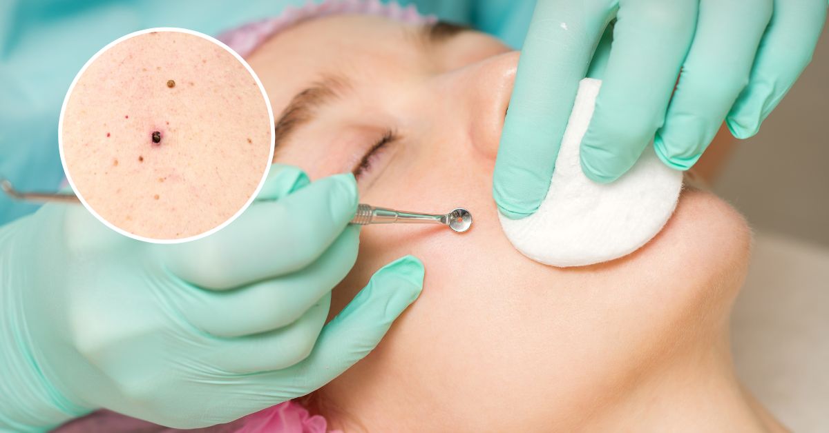 Hướng dẫn cách chăm sóc da mặt bị mụn đầu đen giúp làm sạch da hiệu quả