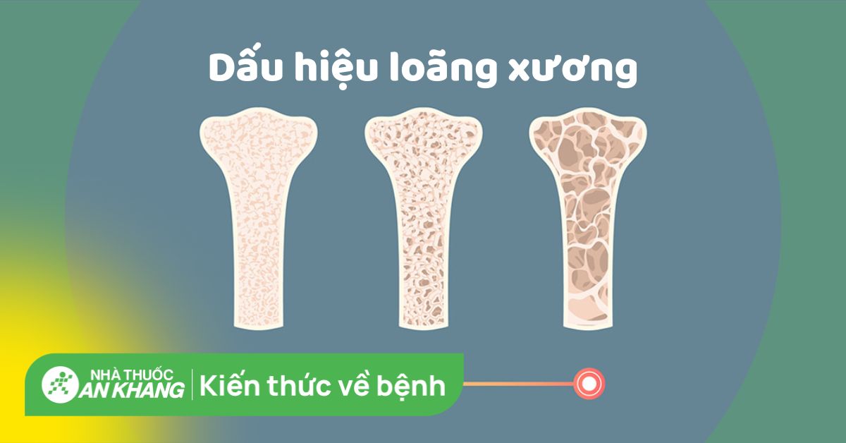 Dấu hiệu loãng xương: Nhận biết sớm để bảo vệ sức khỏe xương