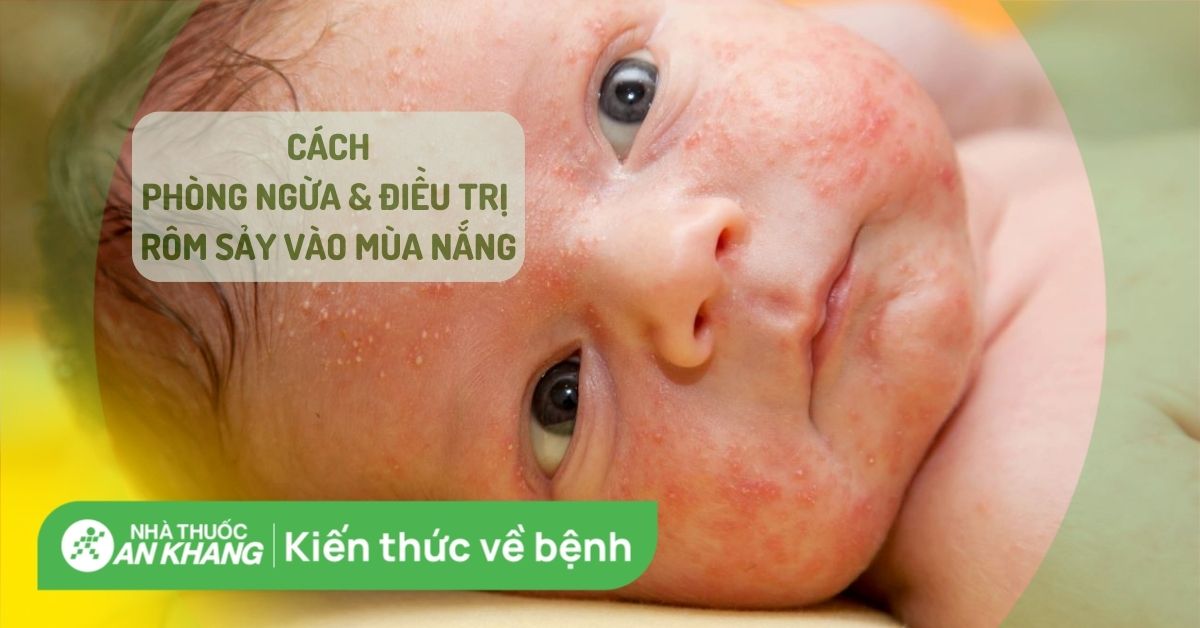 16 cách phòng ngừa và điều trị rôm sảy vào mùa nắng bạn cần biết