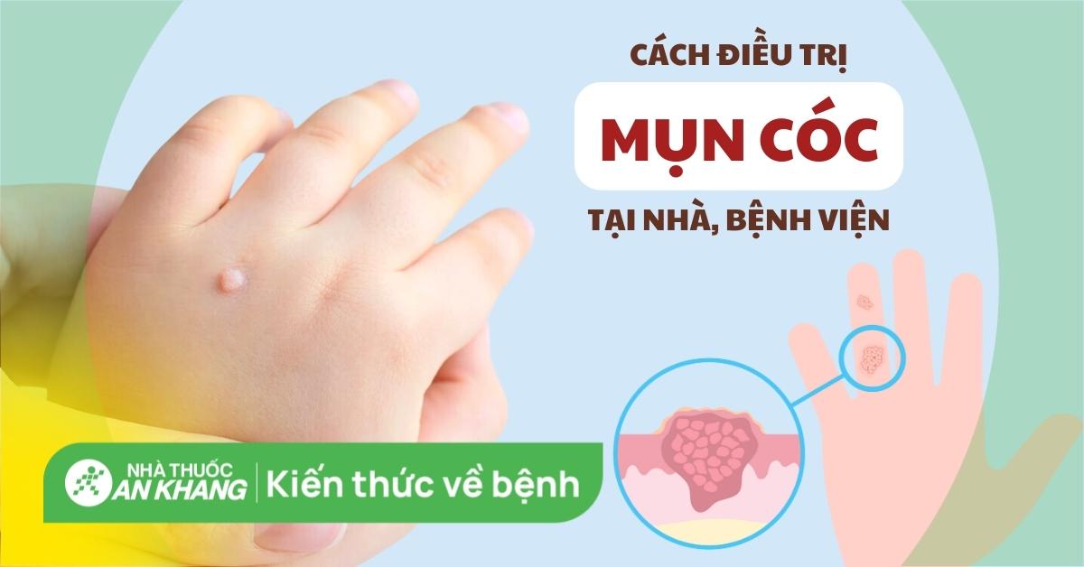 Cách trị mụn cóc tại nhà, bệnh viện hiệu quả và tránh lây lan