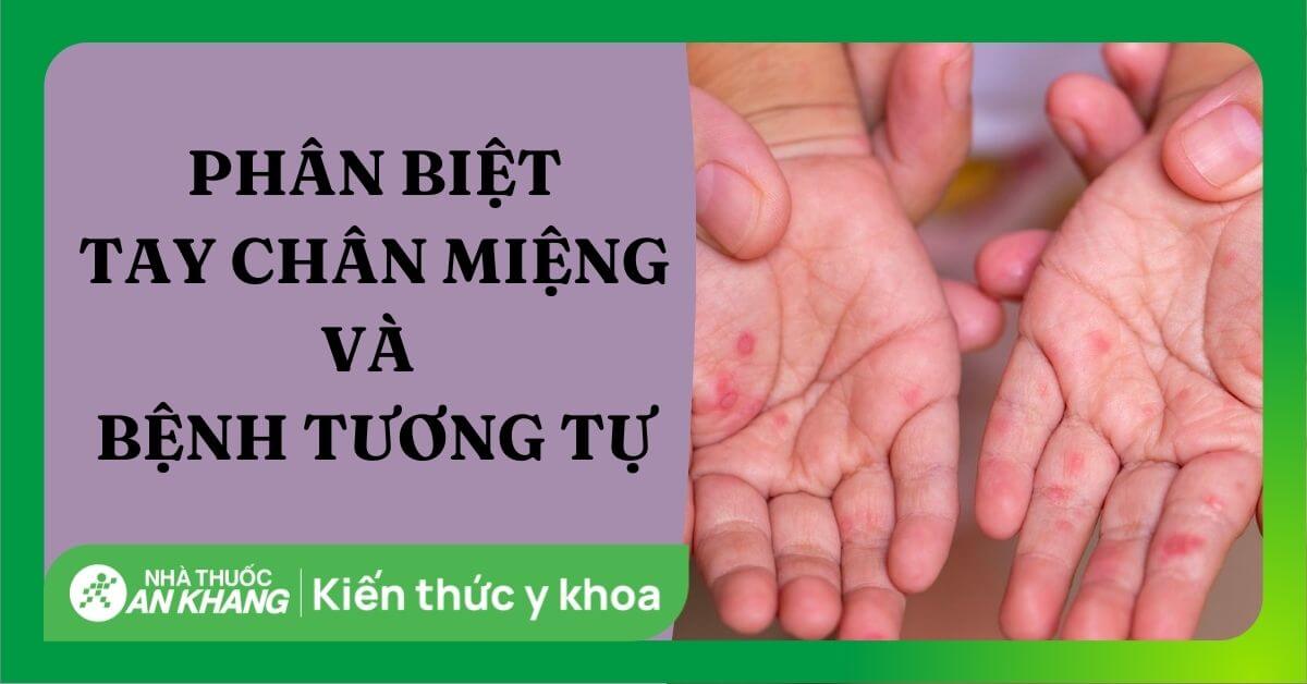 Phân biệt tay chân miệng và bệnh tương tự, các biện pháp phòng ngừa