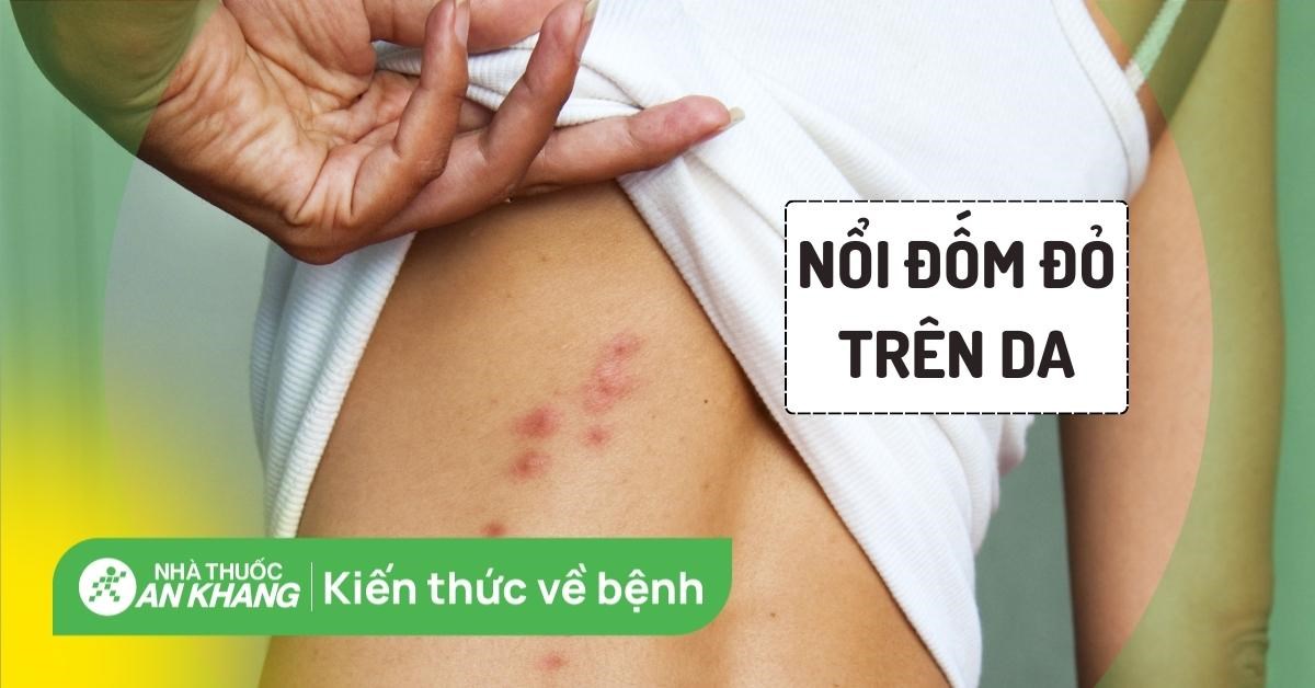 Da bị nổi đốm đỏ: Nguyên nhân, triệu chứng và cách điều trị
