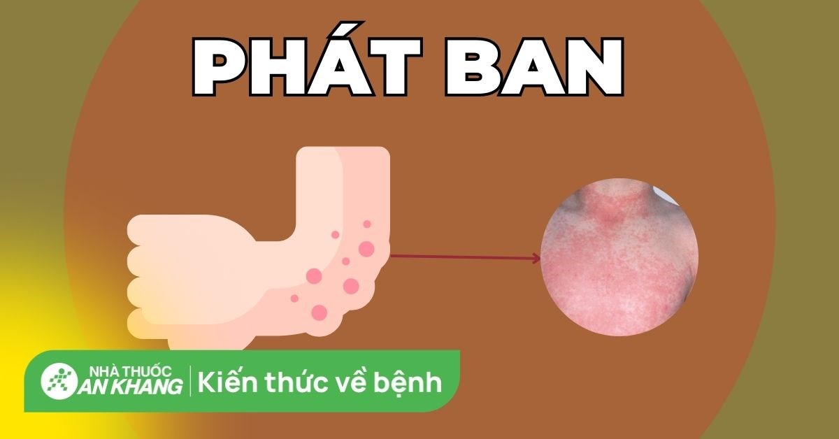 Phát ban trên da là bệnh gì? Nguyên nhân, cách nhận biết và khắc phục