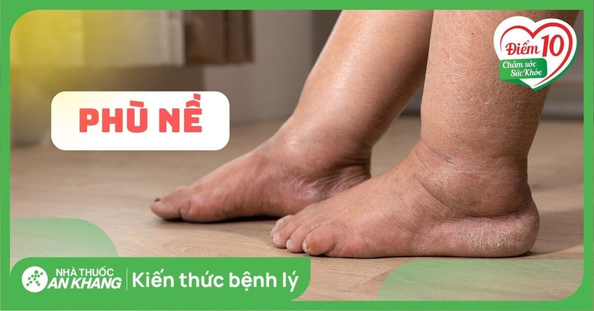 Phù nề là gì? Nguyên nhân và cách điều trị phù nề
