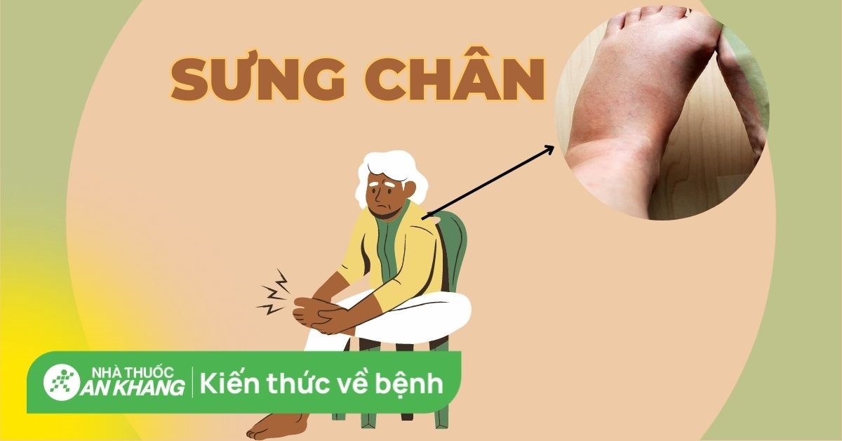 Sưng chân: Nguyên nhân, dấu hiệu, biến chứng và cách điều trị