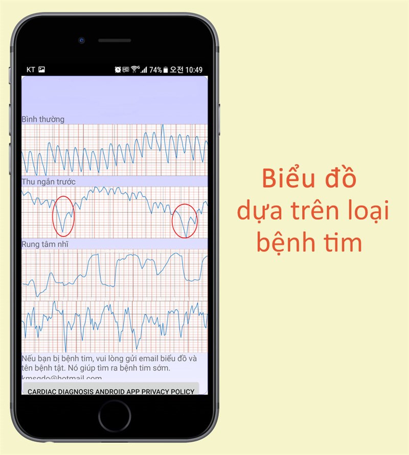 Biểu đồ dựa nhịp tim tr&ecirc;n ứng dụng Chẩn đo&aacute;n tim