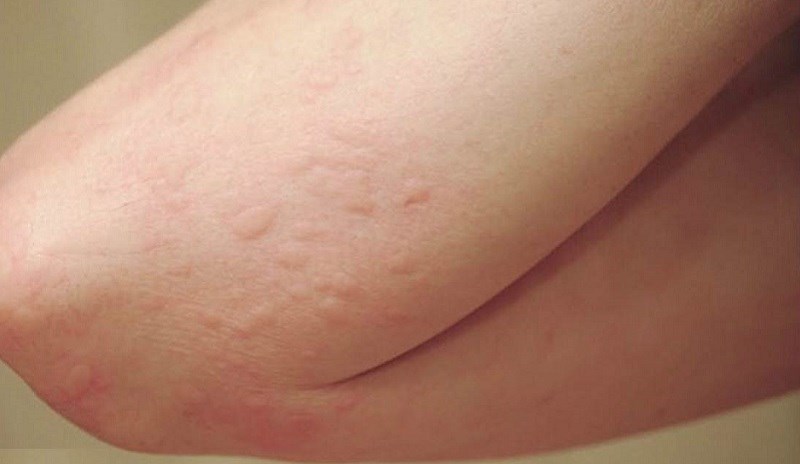 Nguy hiểm đối với những ai bị dị ứng với đậu phộng