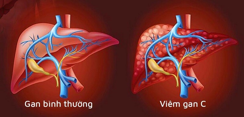 Cảm thảo giúp hỗ trợ điều trị viêm gan C