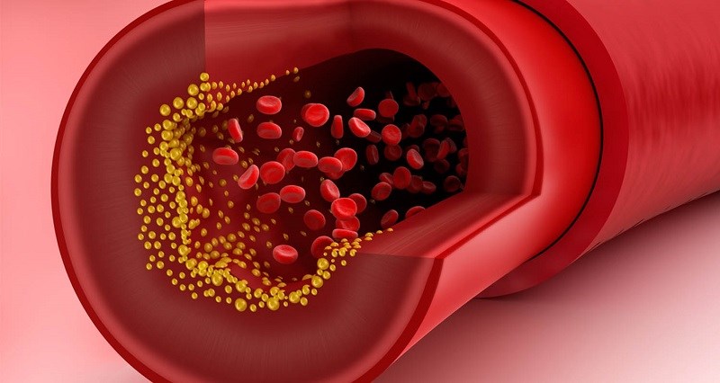 Nước cốt dừa cải thiện lượng cholesterol