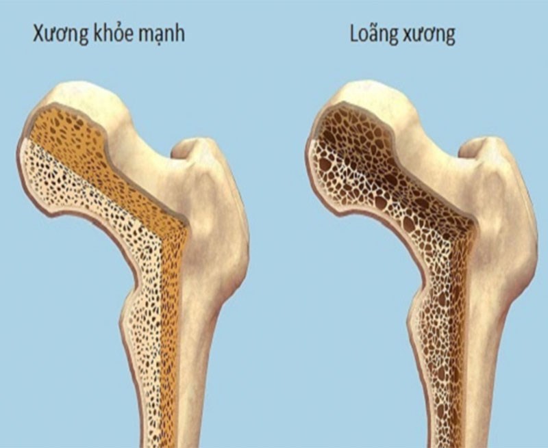  sâm đất ngăn ngừa và hỗ trợ bệnh loãng xương