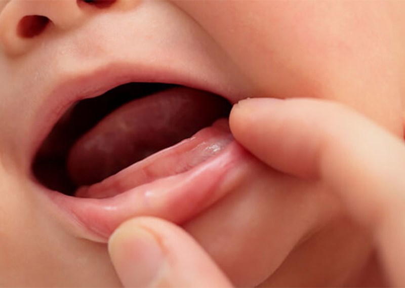 Chữa nhiệt độ miệng