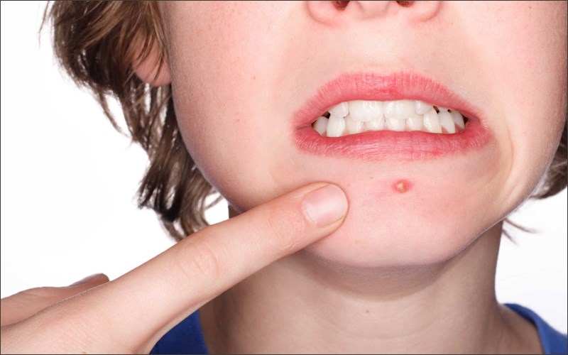 ăn nhiều đường c&oacute; thể g&acirc;y ra mụn trứng c&aacute;