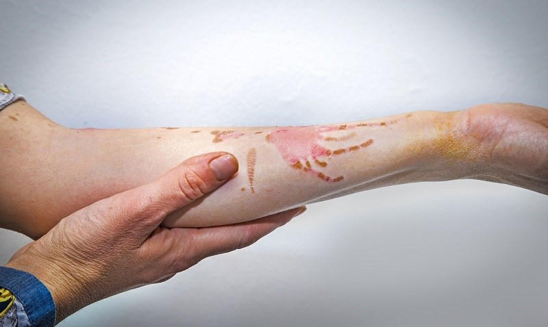 Dầu mtrần góp trị lành các dấu tmùi hương, vết bỏng