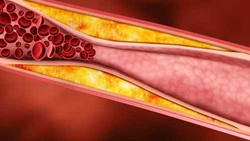 Rễ bồ công anh giúp giảm cholesterol