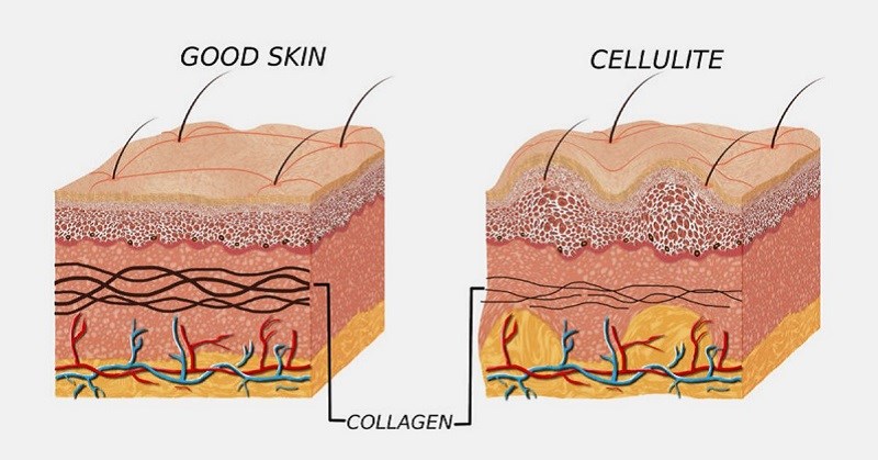 Collagen loại 4