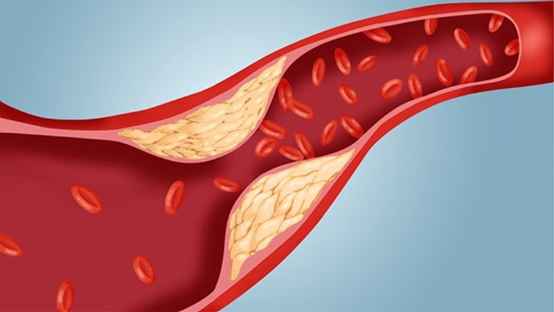 Gà rán làm tăng cholesterol