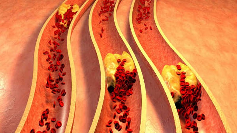 Cây chùm ngây làm giảm cholesterol