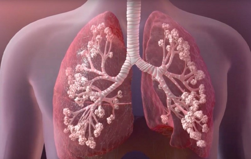 C&oacute; thể điều trị c&aacute;c triệu chứng của bệnh xơ nang