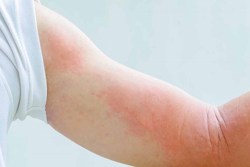 Có thể gây dị ứng