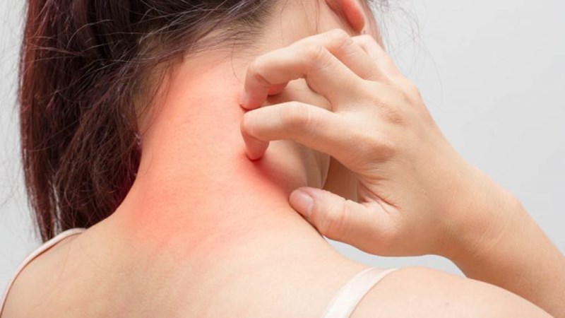 Giảm tình trạng dị ứng