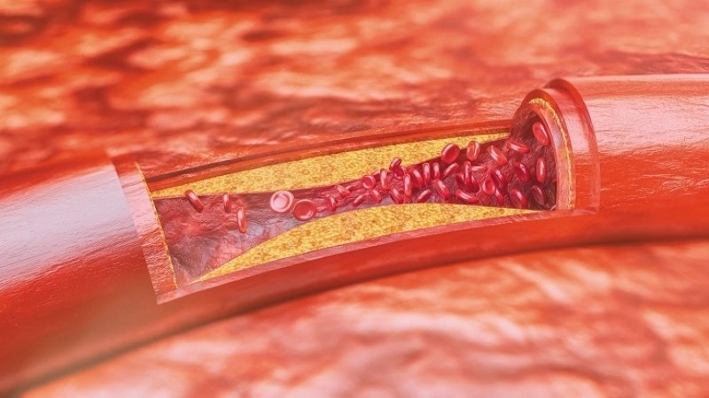 Giảm mức cholesterol LDL