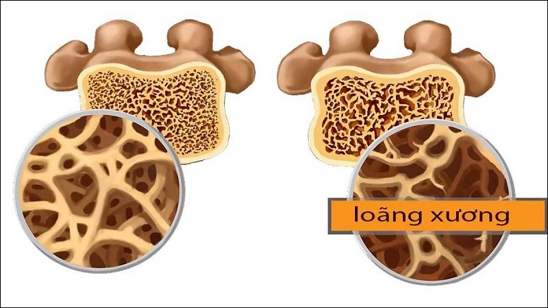 Nhấn vào ảnh để phóng to Trường hợp bị thiếu hụt canxi