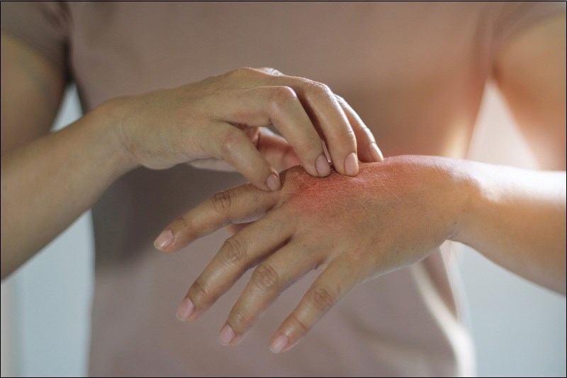 Nhạy cảm với một số cơ địa