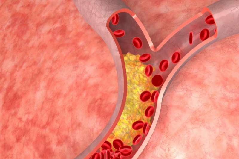 Có thể giảm cholesterol