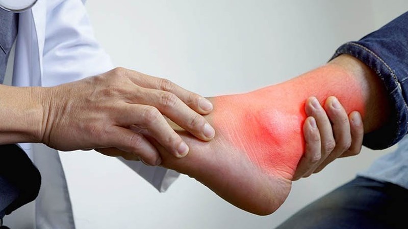 Không ăn súp lơ khi bị bệnh gout