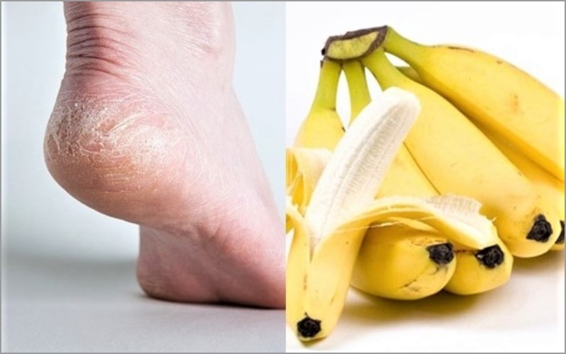  Nứt nẻ tay ch&acirc;n