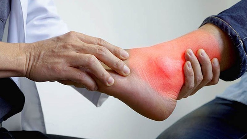 Hỗ trợ điều trị gout