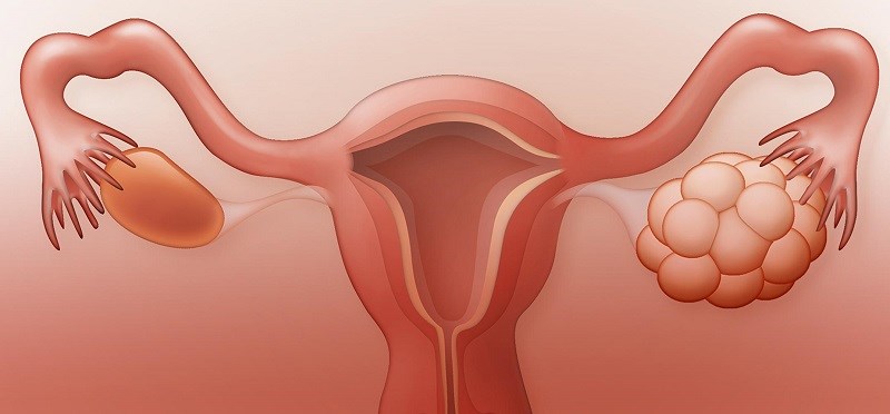 Có thể làm giảm các triệu chứng của hội chứng buồng trứng đa nang (PCOS)