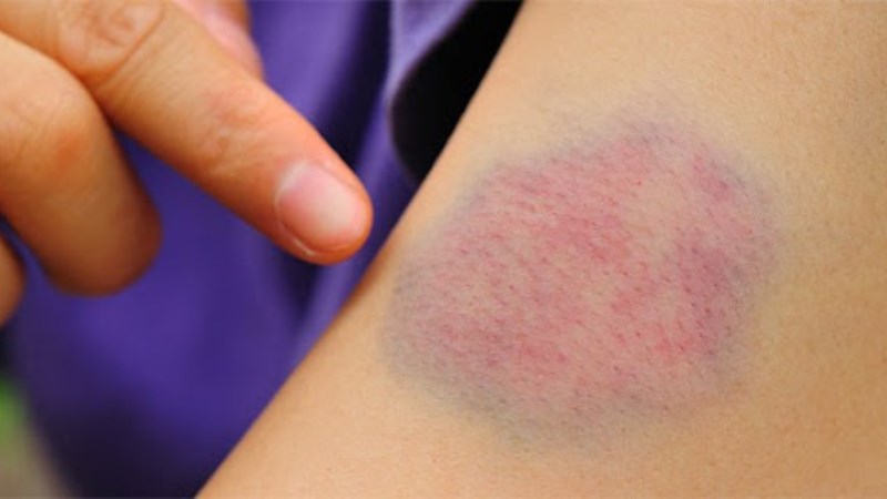 Đ&aacute;nh tan vết bầm