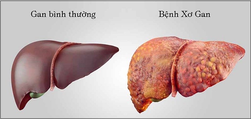 Làm chậm sự tiến triển của bệnh xơ gan