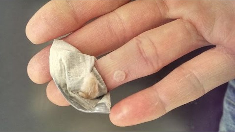 Làm giảm mụn cóc bằng túi trà