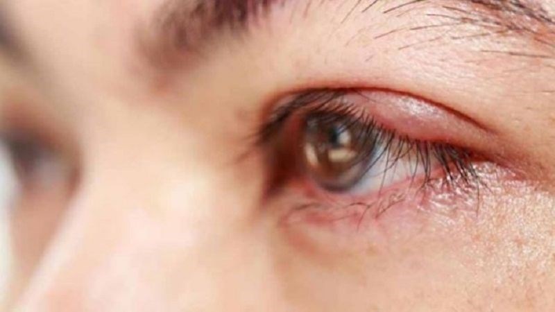 Đau mắt đỏ có thể do vi khuẩn, vi rút hoặc các tác nhân gây dị ứng, kích ứng