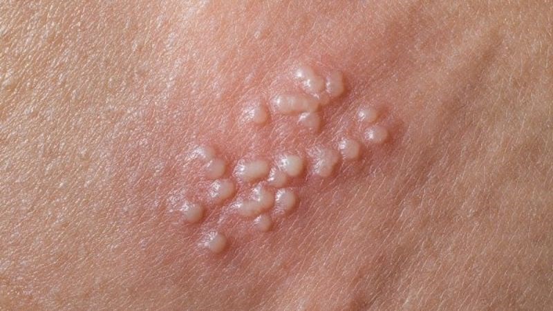 Bệnh lậu do vi khuẩn Neisseria Gonorrhoeae gây ra