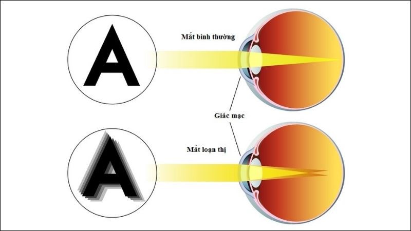 Loạn thị xảy ra do giác mạc có hình dạng bất thường