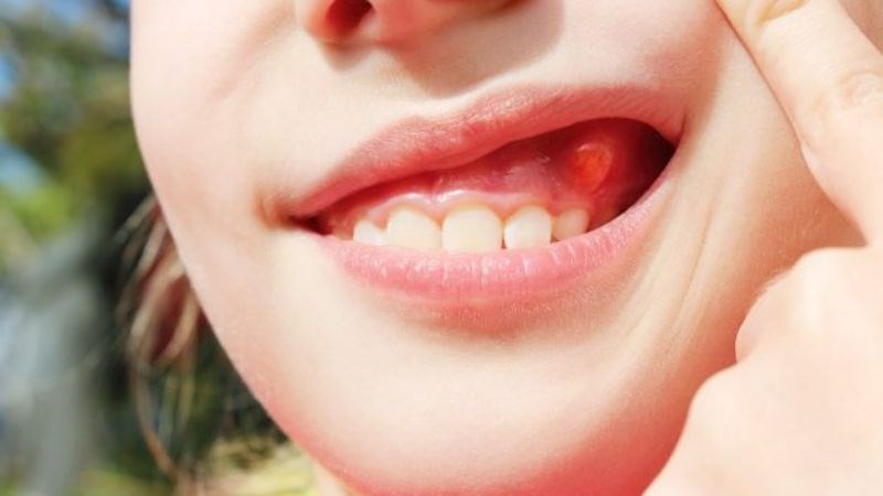 Áp xe răng là các túi mủ do vi khuẩn làm nhiễm trùng gây nên