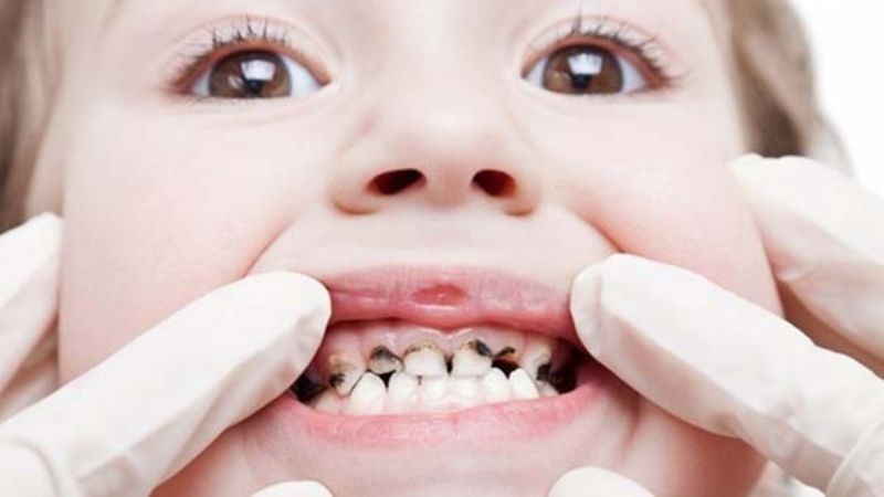 Sâu răng là cơ hội để vi khuẩn phát triển gây ra tình trạng viêm nhiễm