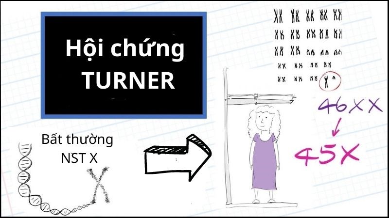 Hội chứng Turner xảy ra khi một NST giới tính X bị mất một phần hoặc toàn bộ