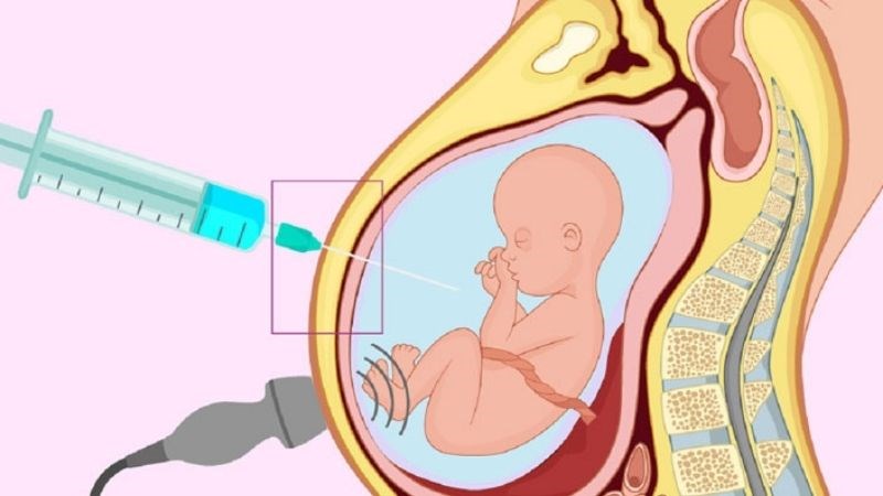Chọc dò ối để xác định bộ NST của thai nhi