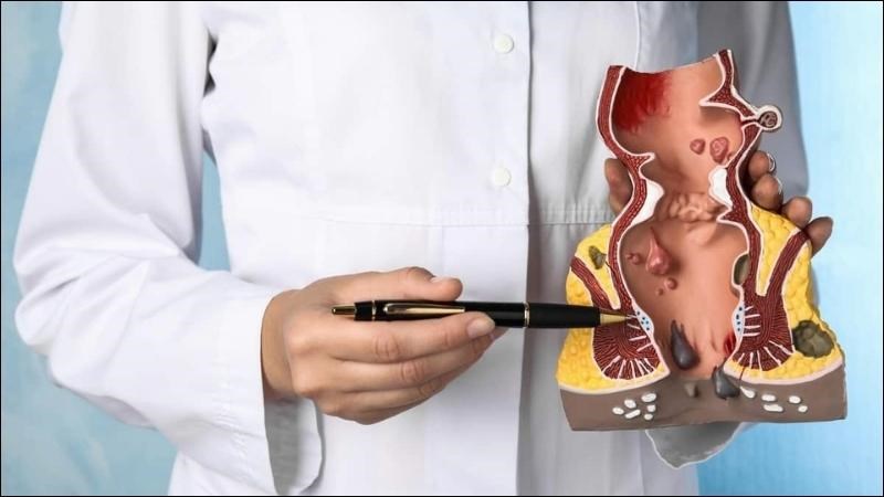 Trĩ là một nguyên nhân thường gặp gây ngứa hậu môn Trĩ là một nguyên nhân thường gặp gây ngứa hậu môn