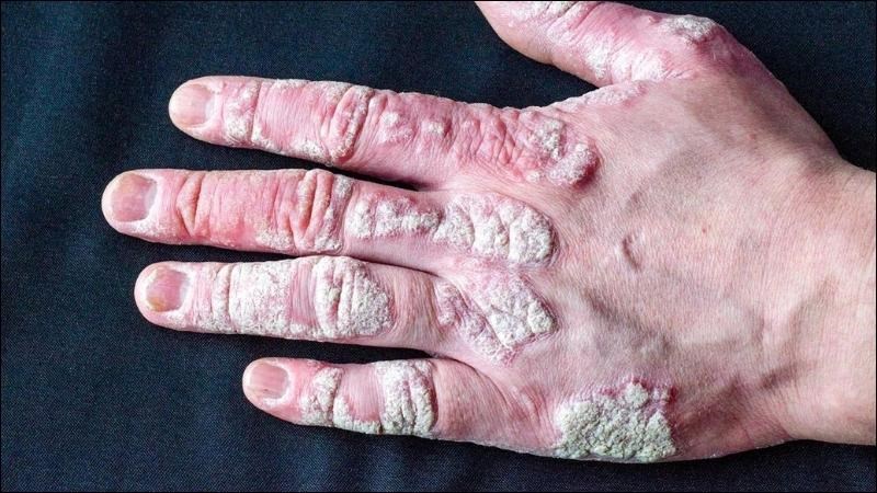 Các bệnh lý da liễu như vảy nến cũng có thể gây ra ngứa hậu môn Các bệnh lý da liễu như vảy nến cũng có thể gây ra ngứa hậu môn