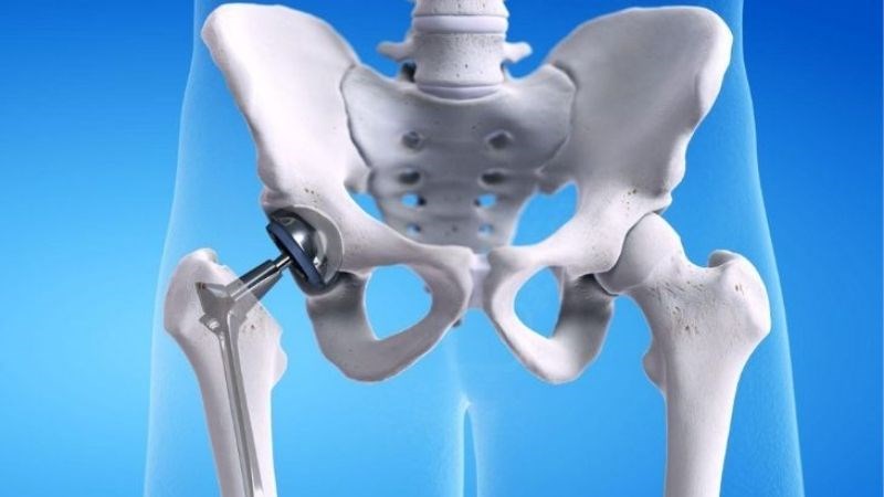 Điều trị thoái hoá khớp háng bằng cách thay khớp háng 